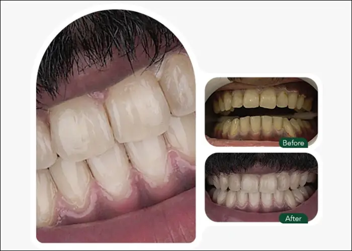 نمونه تغییر رنگ دندان با روش خانگی