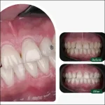 سفید کردن دندان در خانه با راهکارهای ساده اما موثر