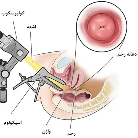 کولپوسکوپی زخم دهانه رحم در کرج